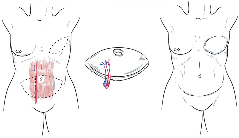 Breast Reconstruction Aesthetics: DIEP Flaps