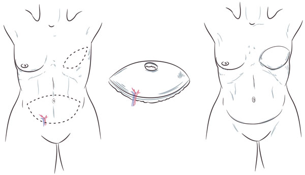 SIEA Flap Breast Reconstruction in Washington, DC - Breast
